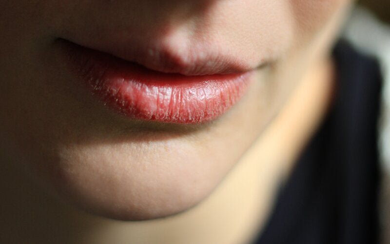 Trockene Lippen: 5 Tipps, die wirklich helfen